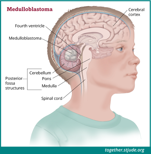 मेडुलोब्लास्टोमा क्या है? मेडुलोब्लास्टोमा, सेरेबेलम का एक मस्तिष्क का कैंसर है। सेरेबेलम, मस्तिष्क के पोस्टेरियर फोसा नामक भाग में पाया जाता है।