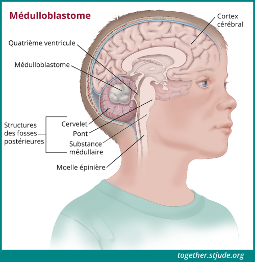 Médulloblastome chez les enfants et les adolescents - Ensemble by ...