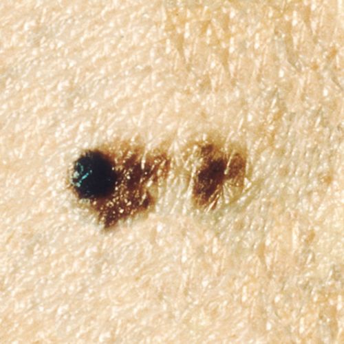 This picture shows a melanoma lesion without a clearly defined border.