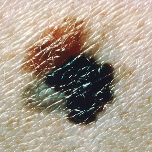 This picture shows a melanoma lesion with varying colors.