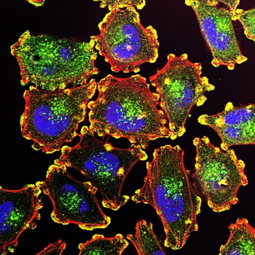 Cette image illustre un élargissement au microscope de cellules de mélanomes métastatiques.