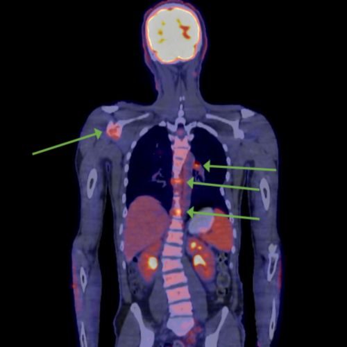 التصوير المقطعي البوزيتروني (PET) لطفل مريض بسرطان الميلانوما النقيلي. الصورة معّلمة للإشارة إلى مناطق انتشار سرطان الميلانوما.