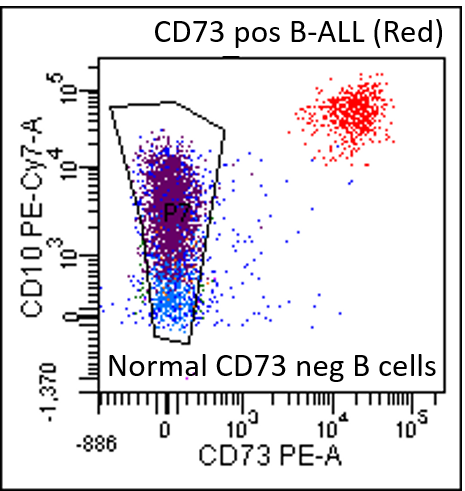 Sample flow cytometry chart shows minimal residual disease as a red cluster in the upper right quadrant of the chart in a pediatric patient with B-cell acute lymphoblastic leukemia