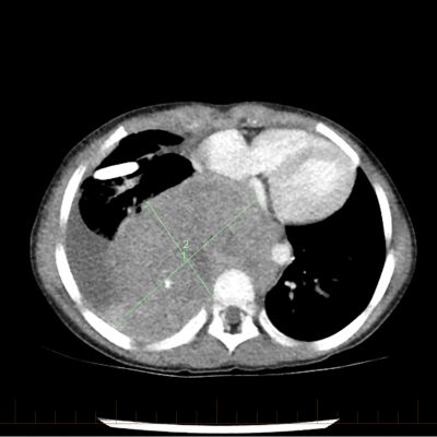 Obraz TK klatki piersiowej pacjenta przedstawiający nerwiaka zarodkowego w momencie postawienia wstępnej diagnozy.