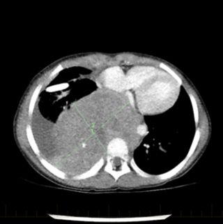 O exame de tomografia computadorizada (TC) do tórax de um paciente mostra um tumor de neuroblastoma no momento do diagnóstico inicial.