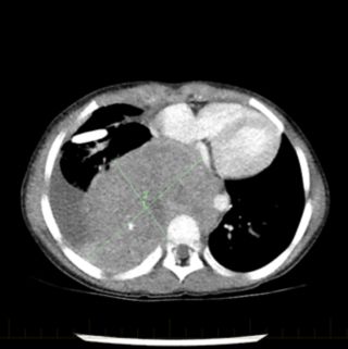 Escaneo por TC del pecho de un paciente que muestra un tumor de neuroblastoma al momento del diagnóstico inicial.