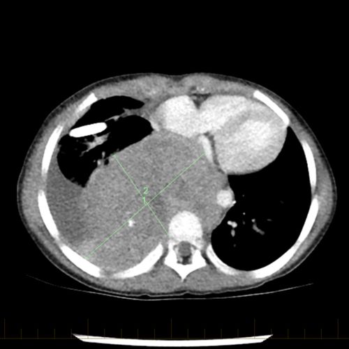 La tomodensitométrie du thorax d'un patient révèle un neuroblastome au moment du diagnostic initial.