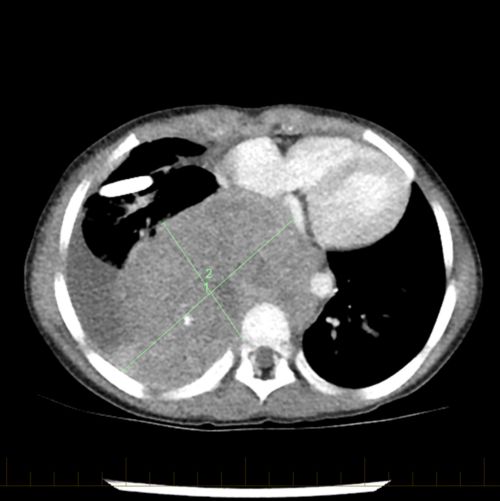 O exame de tomografia computadorizada (TC) do tórax de um paciente mostra um tumor de neuroblastoma no momento do diagnóstico inicial.