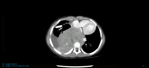 Neuroblastoma scan