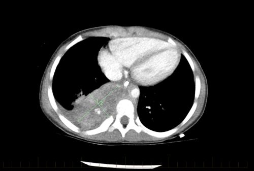 TC do tórax com evidências de neuroblastoma em um paciente pediátrico