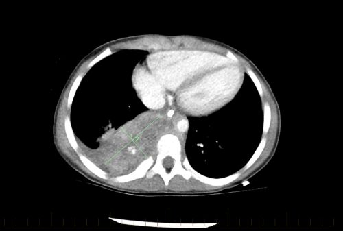 La tomodensitométrie du thorax montre la présence d'un neuroblastome chez le patient pédiatrique.