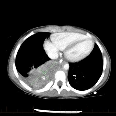 For patients with intermediate or high risk neuroblastoma, chemotherapy is a main treatment. After one course of chemotherapy, the neuroblastoma tumor decreased in size.