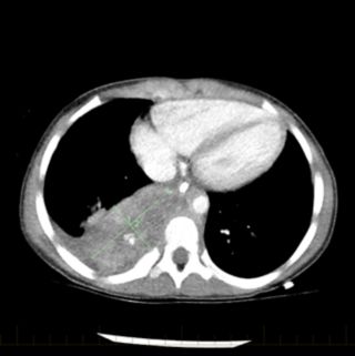 Pour les patients présentant un neuroblastome à risque intermédiaire ou élevé, la chimiothérapie est l'un des traitements principaux. Après un cycle de chimiothérapie, la taille du neuroblastome a diminué.