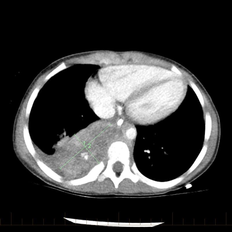 For patients with intermediate or high risk neuroblastoma, chemotherapy is a main treatment. After one course of chemotherapy, the neuroblastoma tumor decreased in size.