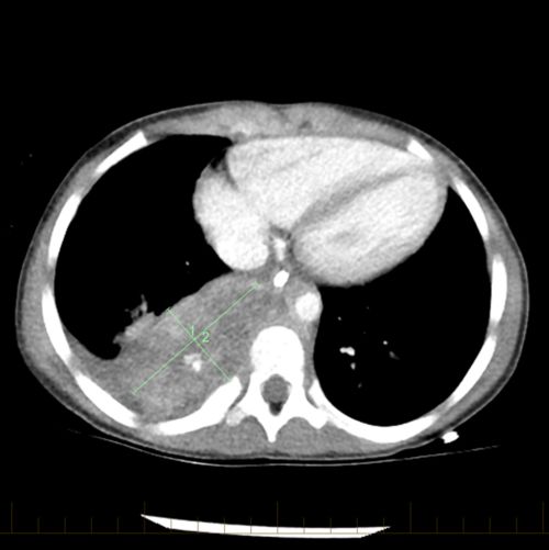 Pour les patients présentant un neuroblastome à risque intermédiaire ou élevé, la chimiothérapie est l'un des traitements principaux. Après un cycle de chimiothérapie, la taille du neuroblastome a diminué.