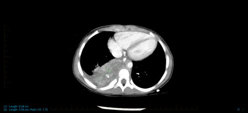 Neuroblastoma scan