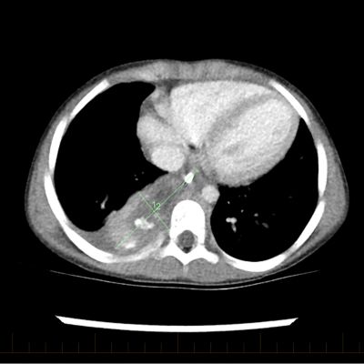 After a second course of chemotherapy, the tumor is even smaller.