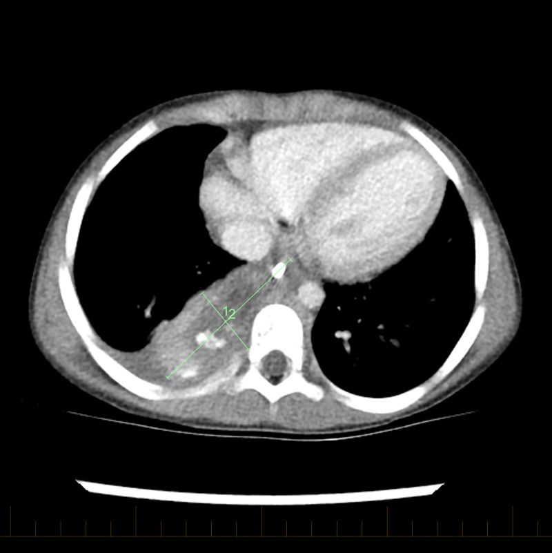 After a second course of chemotherapy, the tumor is even smaller.