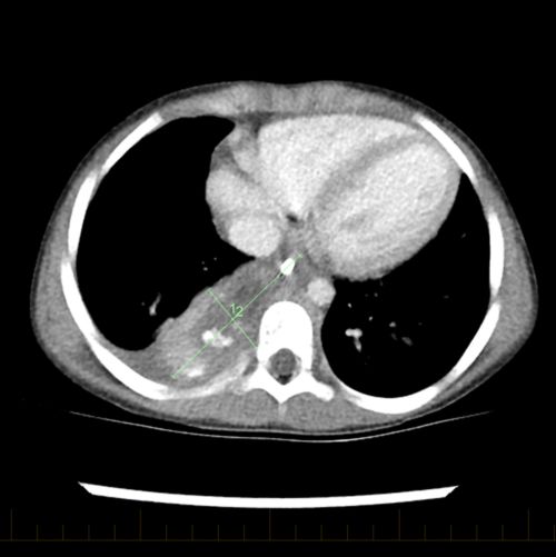 Após um segundo ciclo de quimioterapia, o tumor está ainda menor.