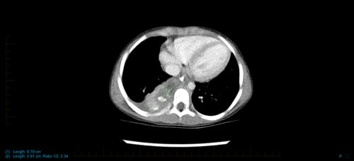 Neuroblastoma scan