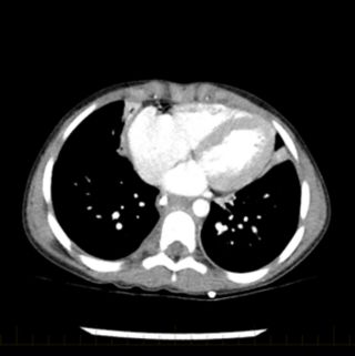 La chirurgie est utilisée pour retirer la tumeur lorsque cela est possible. Le scanner montre le thorax du patient après l'intervention chirurgicale.