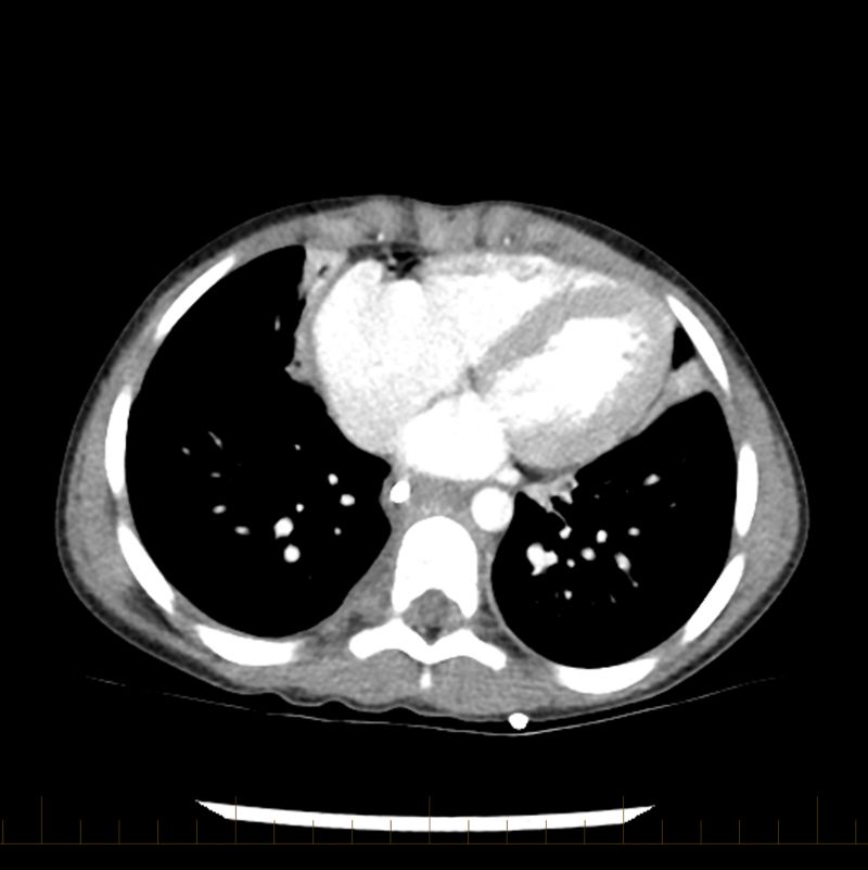 Surgery is used to remove the tumor when possible. The scan shows the patient’s chest following surgery.