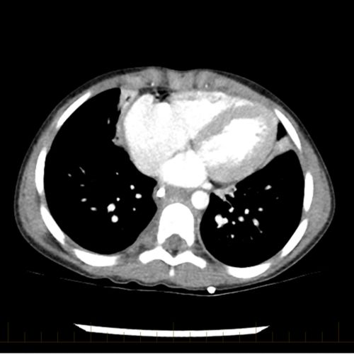 A cirurgia é usada para remover o tumor quando possível. O exame mostra o tórax do paciente após a cirurgia.