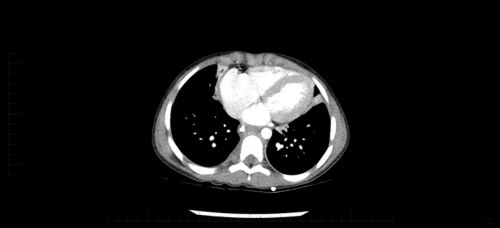 Neuroblastoma scan