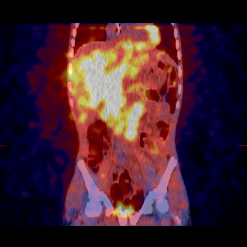 MIBG 扫描影像中显示的神经母细胞瘤