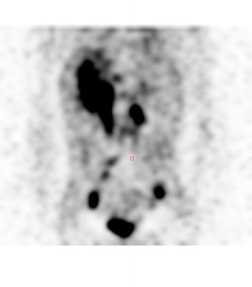 Exploración con MIBG de un neuroblastoma en un paciente pediátrico