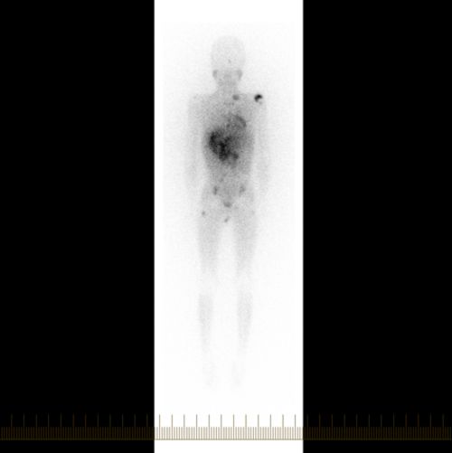 Whole body MIBG scan from the front, or anterior, view of a neuroblastoma patient.