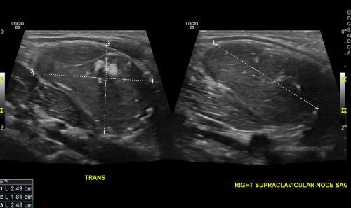 Ultrasonido que muestra masa suprarrenal en un paciente pediátrico con neuroblastoma