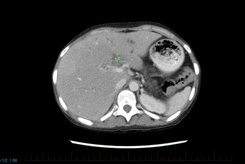 TC abdominal com evidências de linfoma não Hodgkin em um paciente pediátrico