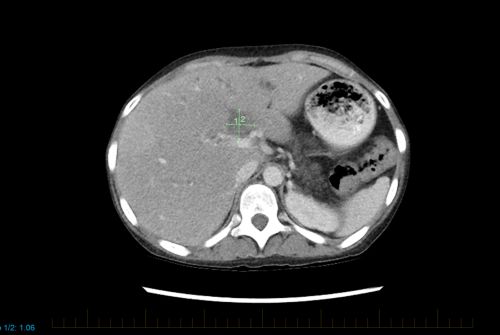 TC abdominal de un paciente pediátrico con evidencia de linfoma no Hodgkin