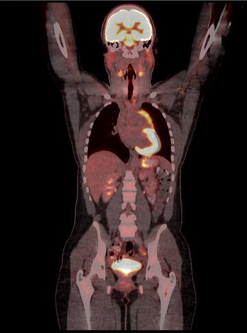 پیڈیاٹرک نان ہوڈکن لیمفوما کے مریض کا PET CT اسکین