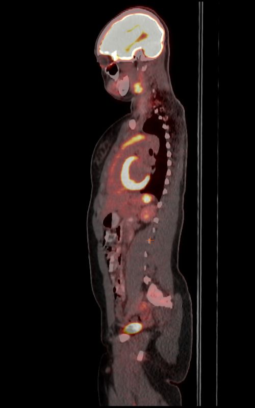 Exame PET-CT do plano lateral de um paciente pediátrico com linfoma não Hodgkin