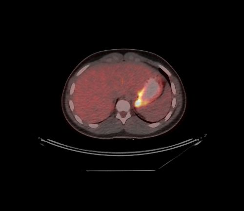 پیڈیاٹرک نان ہوڈکن لیمفوما کے مریض کا محوری پلین PET CT اسکین