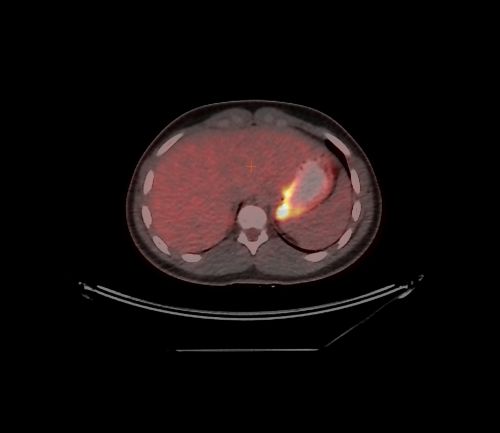 Exame PET-CT do plano axial de um paciente pediátrico com linfoma não Hodgkin