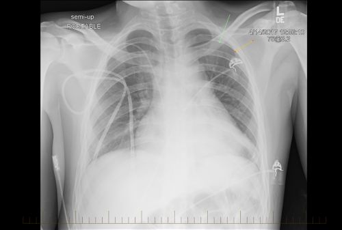 Rayos X del tórax de un paciente pediátrico con linfoma no Hodgkin con evidencia de enfermedad.