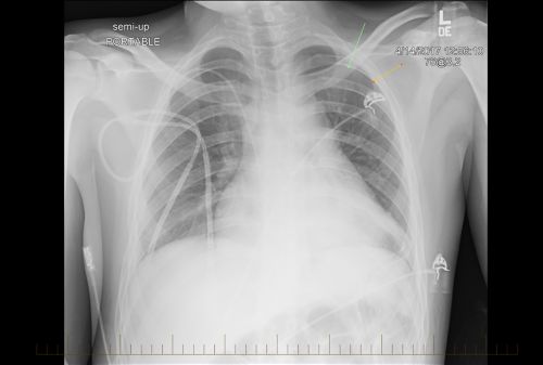 Chest X-ray of pediatric non-Hodgkin lymphoma patient shows evidence of disease