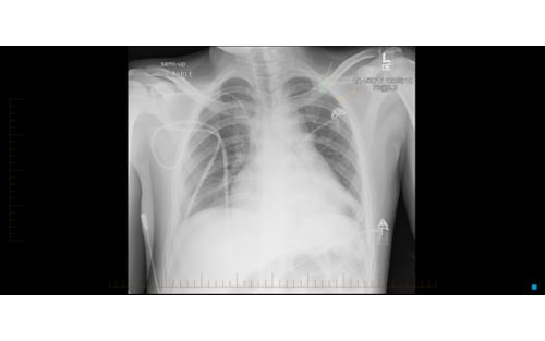 Non-Hodgkin lymphoma xray of a patient's chest