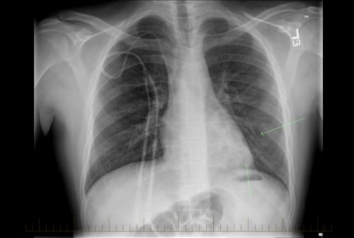 Radiografia de tórax com evidência de linfoma não Hodgkin em paciente pediátrico.