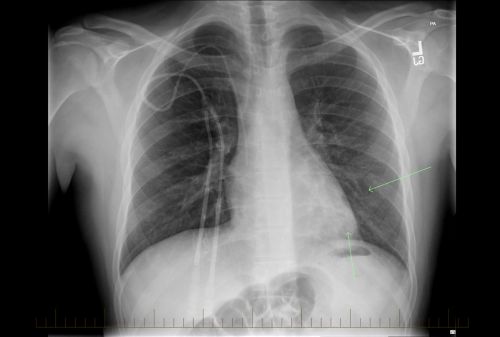 Hodgkin မဟုတ်သော ပြန်ရည်ကျိတ်ကင်ဆာဝေဒနာရှင် ကလေးလူနာ၏ ရောဂါလက္ခဏာပြပြီဖြစ်သည့် ရင်ဘတ် X-ray ဓာတ်မှန်။