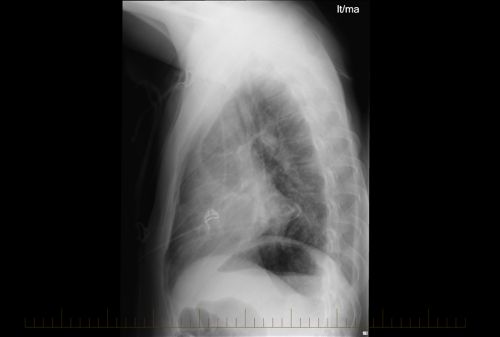 Rayos X laterales de un linfoma no Hodgkin pediátrico con evidencia de enfermedad.