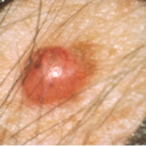 यह तस्वीर एक त्वचा कैंसर के घाव को दिखाती है जो कठोर और लाल है।