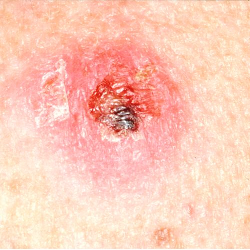 This picture shows a skin cancer lesion that has a scab.