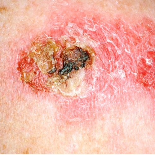 This picture shows a skin cancer lesion that is red and brown, very rough, and scaly.