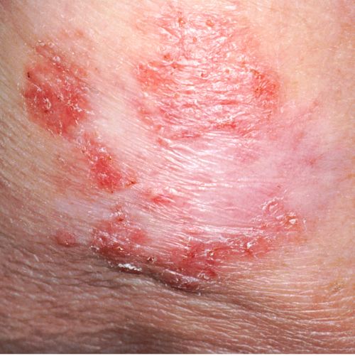 En esta imagen, se muestra una lesión de cáncer de piel que es plana, seca y escamosa.