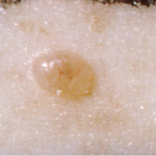 यह तस्वीर त्वचा के कैंसर के घाव को दिखाता है जो छोटा, चिकना, चमकदार और पीला है।