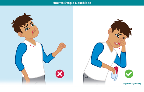 To treat a nosebleed, sit up straight and tilt the head slightly forward. Pinch the outside of the nose and apply pressure for about 10 minutes. 